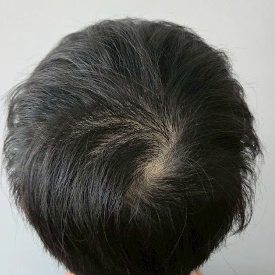 施作前2